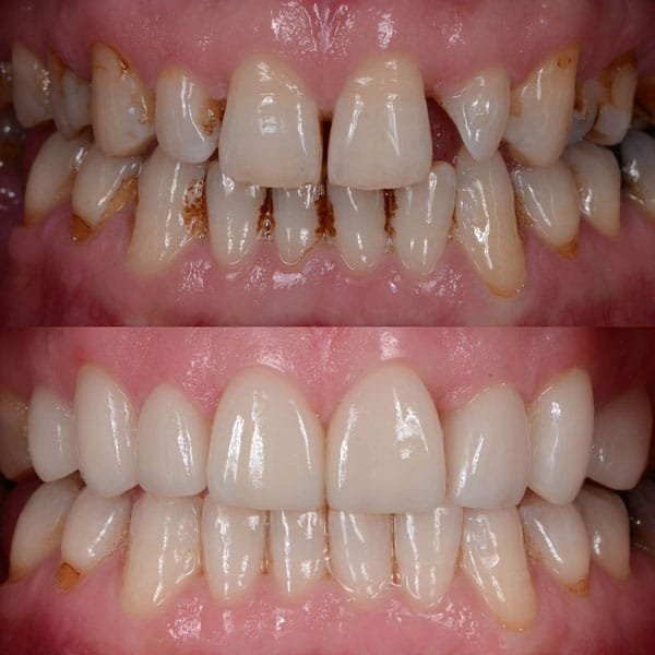 Full Mouth Rehabilitation