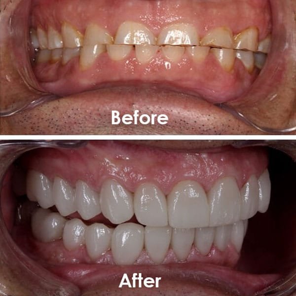 Full Mouth Rehabilitation