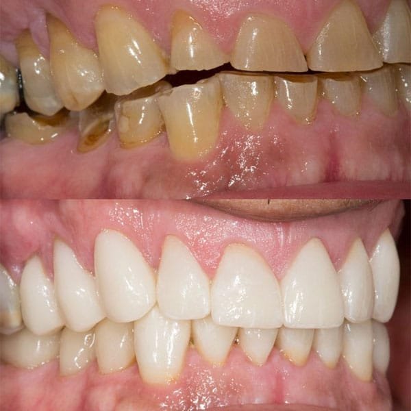 Full Mouth Rehabilitation