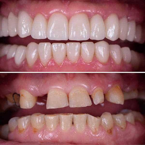 Full Mouth Rehabilitation