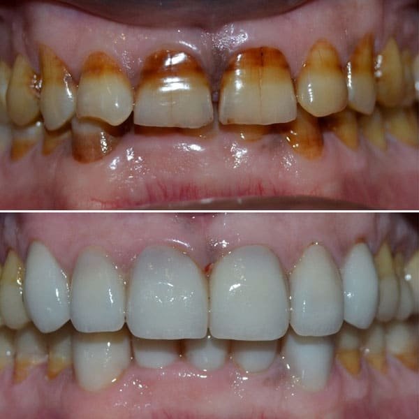 Full Mouth Rehabilitation