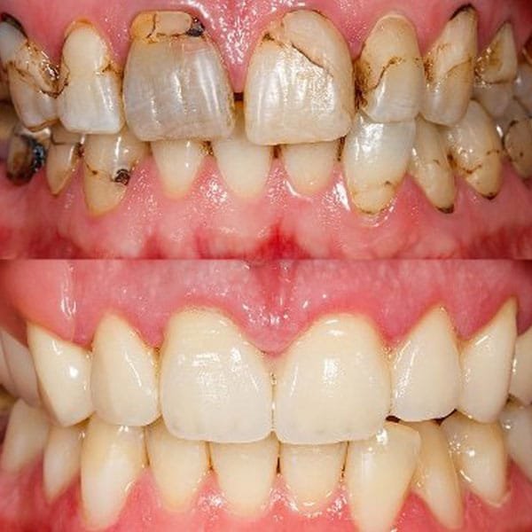 Full Mouth Rehabilitation
