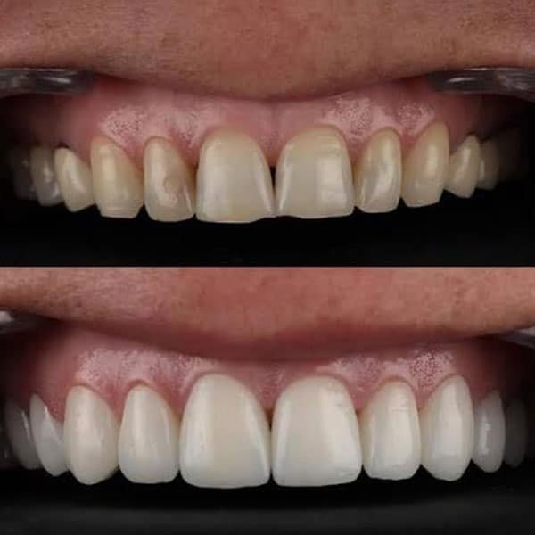 Smile Designing