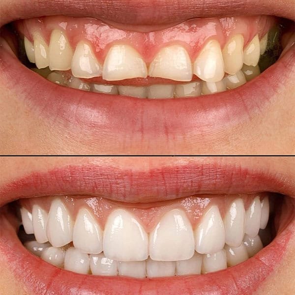 Smile Designing