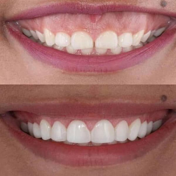 Smile Designing