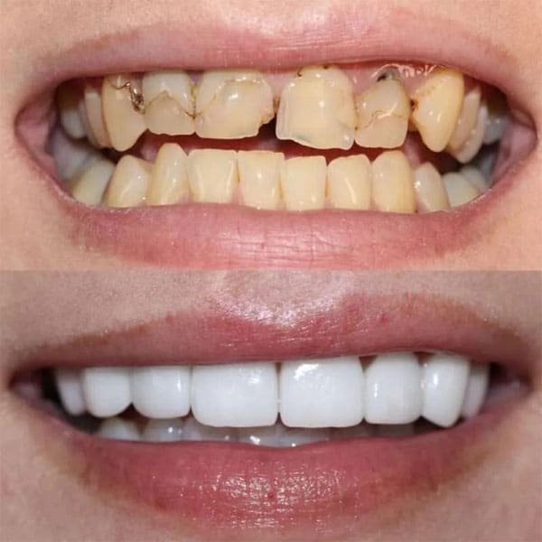 Veneer