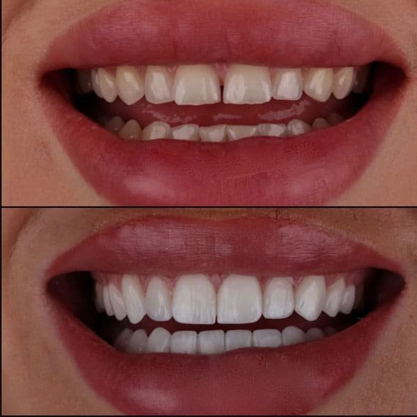 Veneer
