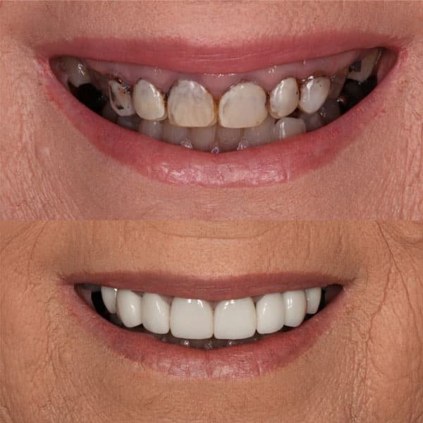 Veneer